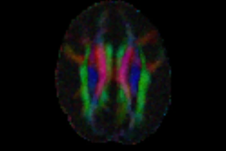 Colours of the principal diffusion direction on an axial slice, brighter where FA is high