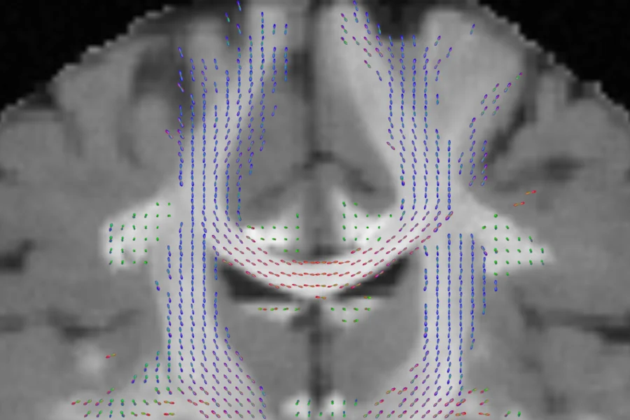 FOD glyphs on a coronal slice: the corpus callosum arching left to right in red, the corticospinal tracts running up and down in blue
